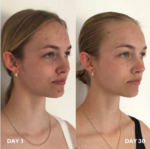 Clinisoothe voor en na gebruik afbeelding 2