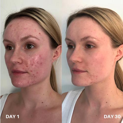 Clinisoothe voor en na gebruik afbeelding 4