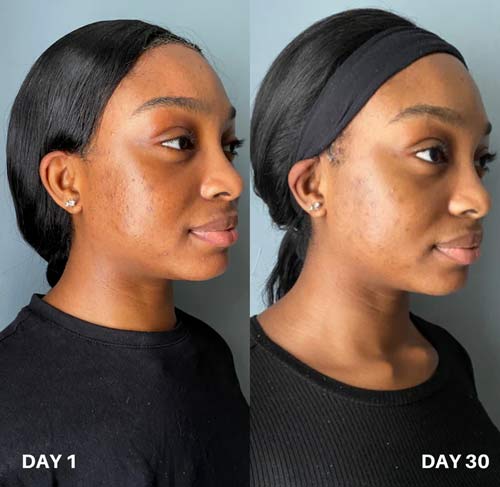 Clinisoothe voor en na gebruik afbeelding 7